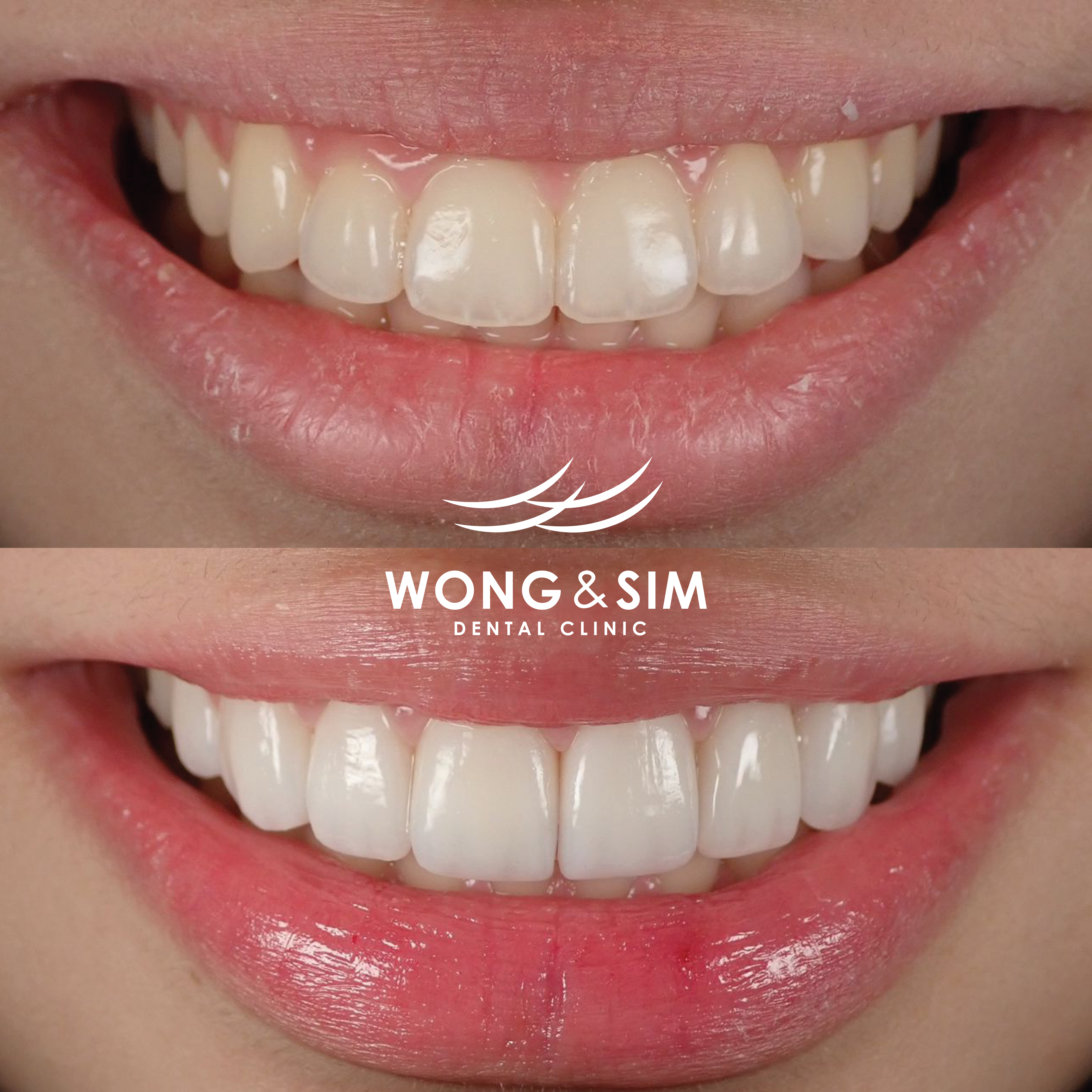Patient 1 - Smile Makeover Before and After
